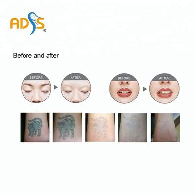 Carbon Peeling ND Yag Laser Machine 6ns For Vascular Removal