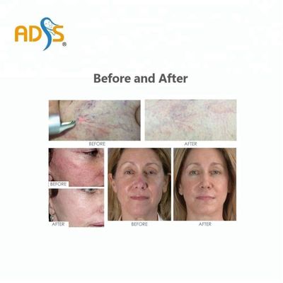 980nm Diode Laser Vascular Removal Machine , Spider Vein Removal Machine