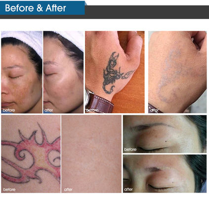 Vertical Beauty Picosecond Laser Machine Pigmentation Removal Laser Machine